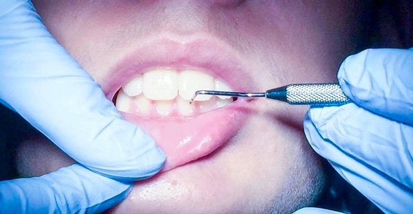 Paziente sottoposto a pulizia dei denti